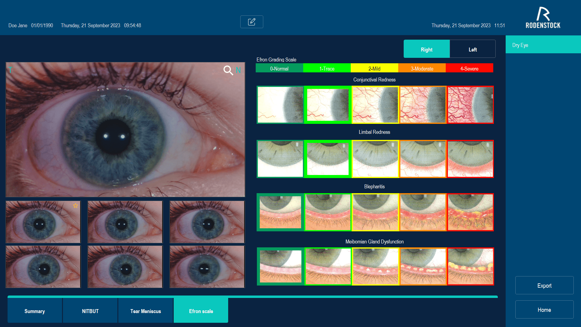 Celovita analiza solznega filma - pregled meibomovih žlez in lipidnega sloja