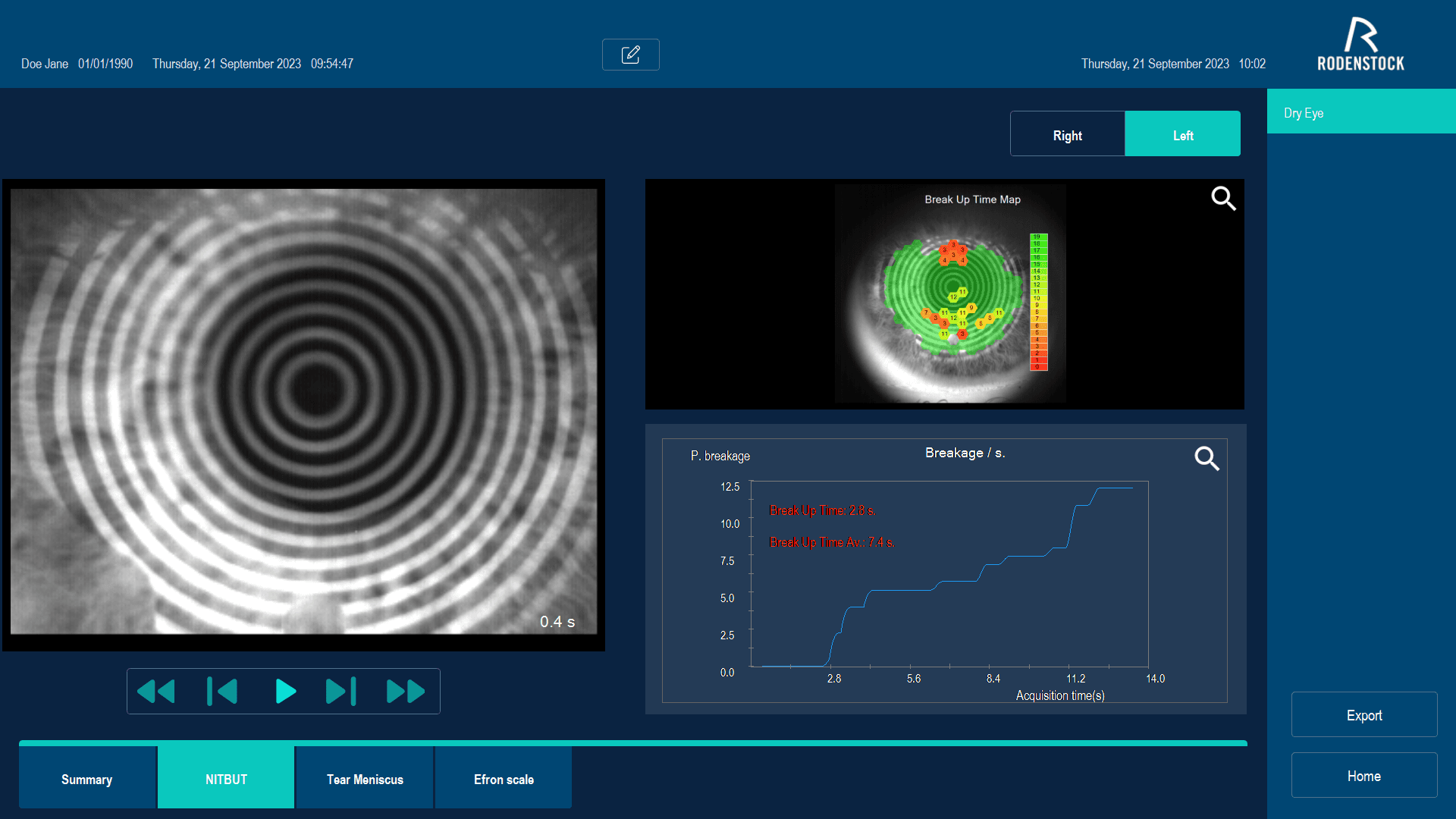 Analiza solznega filma - čas razpada solznega filma